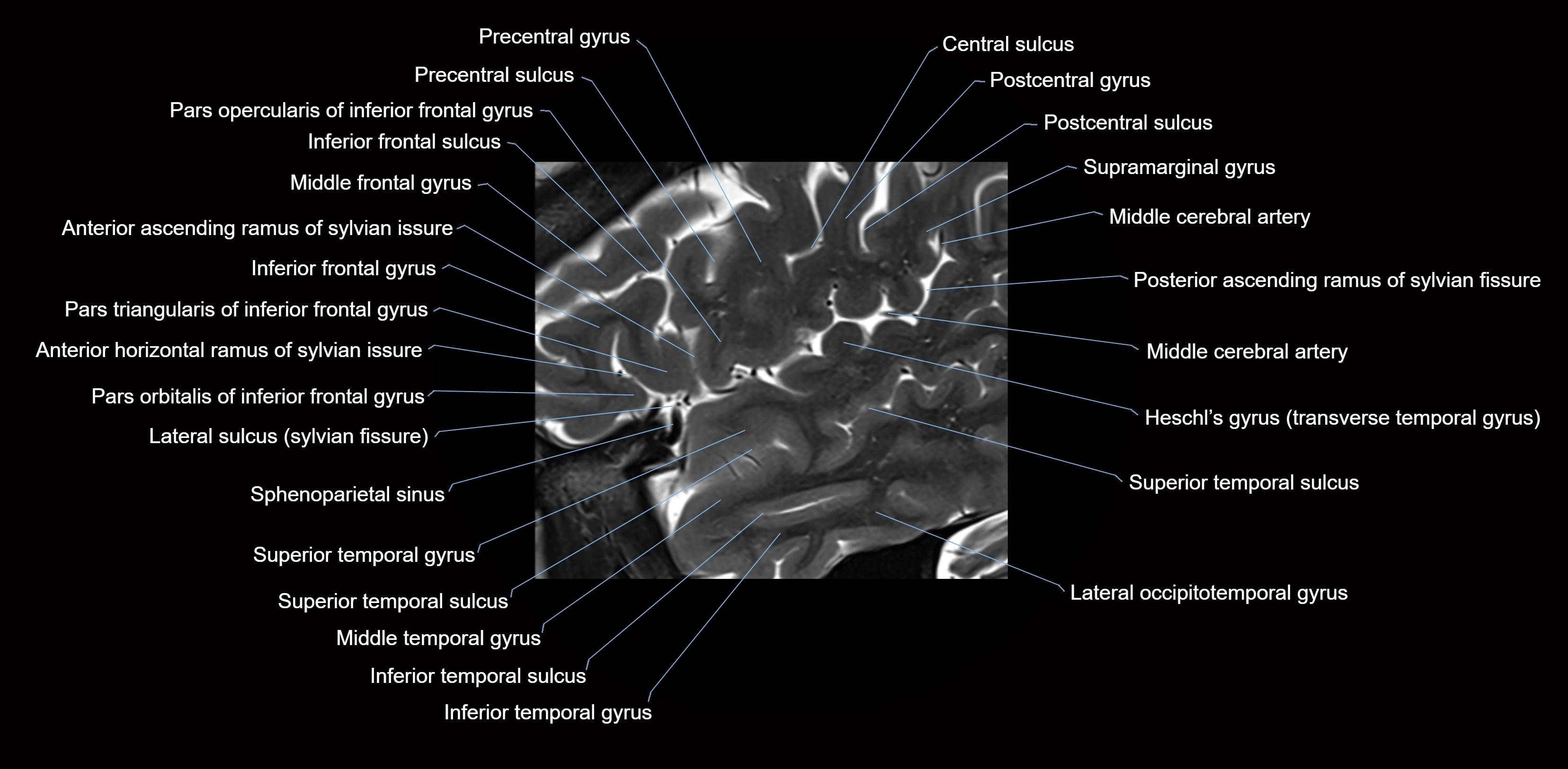 Insula cross section anatomy MRI sagittal 3t labelled image-img-00001.webp